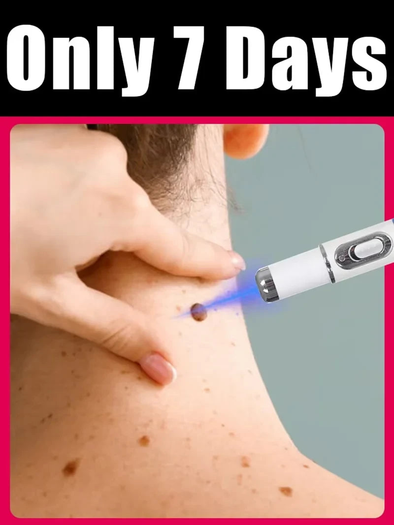 Blue Light Wart Pen